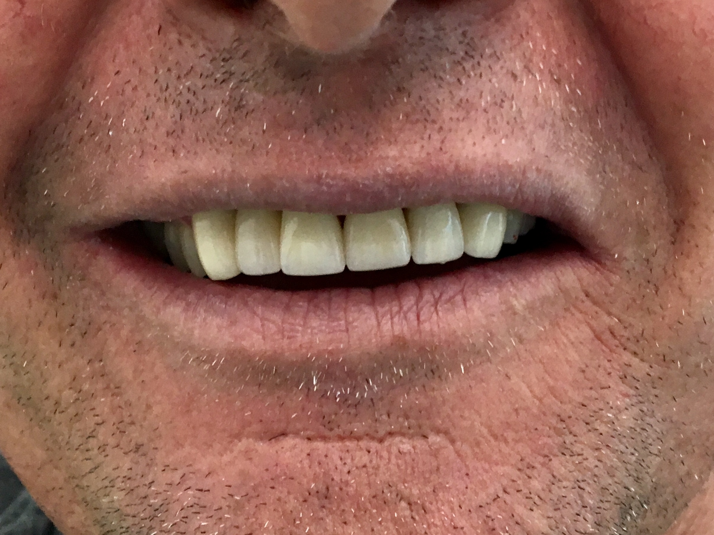 Review Implant Bangkok Dental Dentist Clinic By Bangkok Smile Dental 